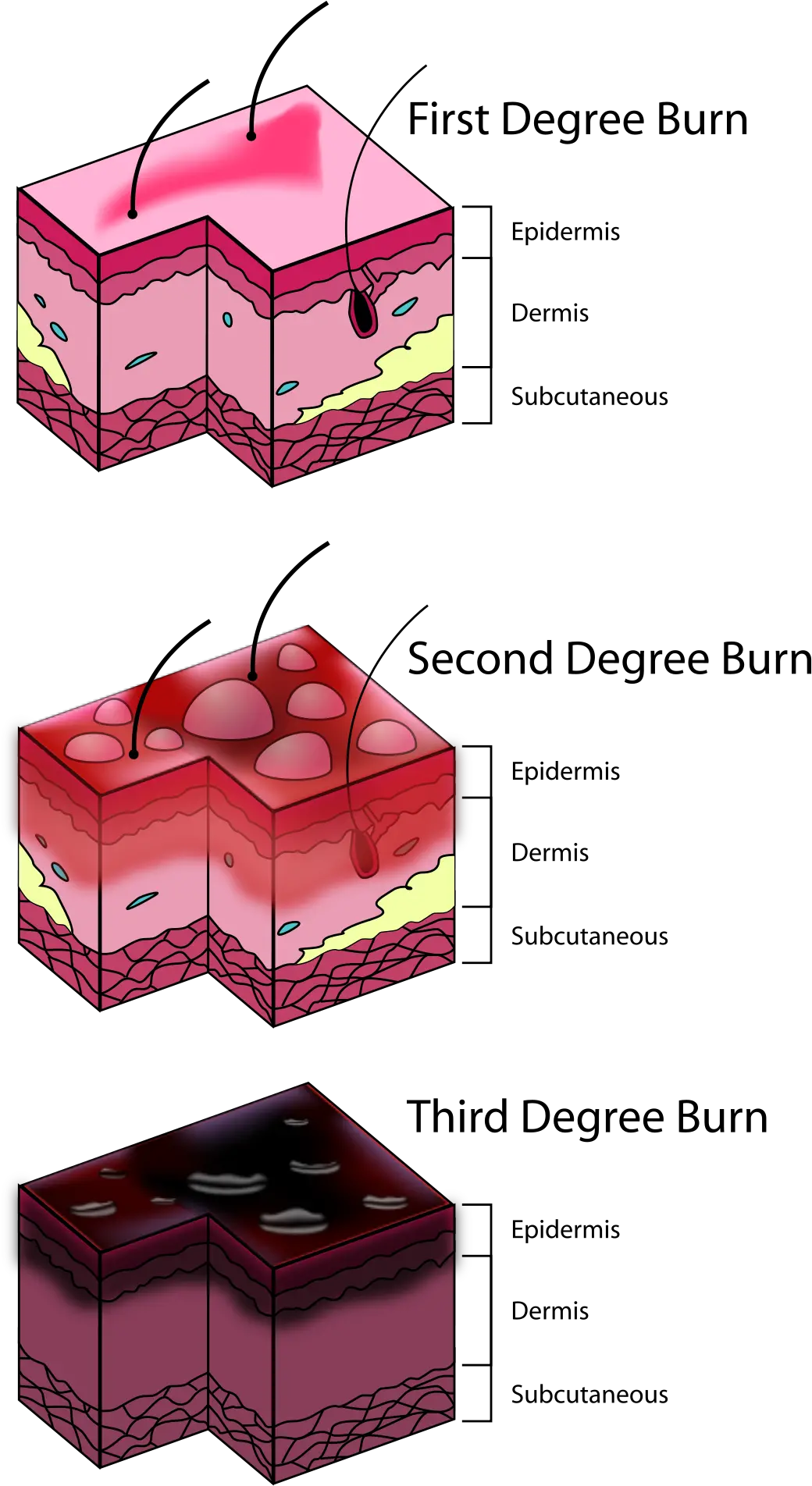  Burn Degree Diagram Should I Put A Bandaid On A Burn Png Burn Png