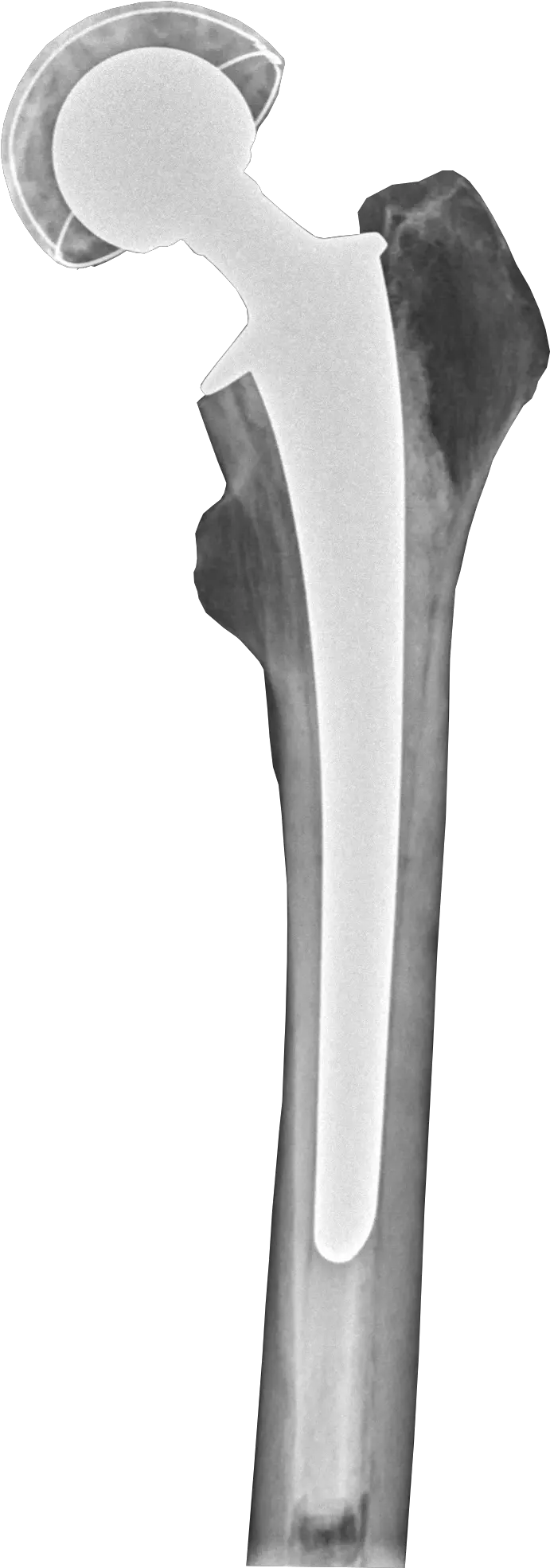  Filepostoperative Radiograph Of Hip Prosthesis Splitting Maul Png Axe Transparent