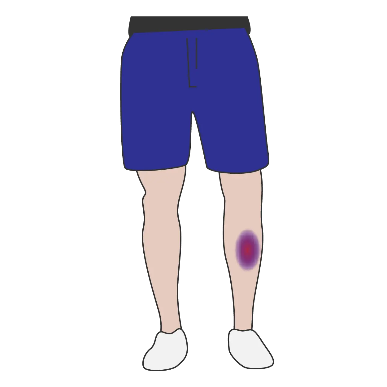  Bruising Clipart Knee Download Board Bruise Clipart Black And White Png Bruise Png