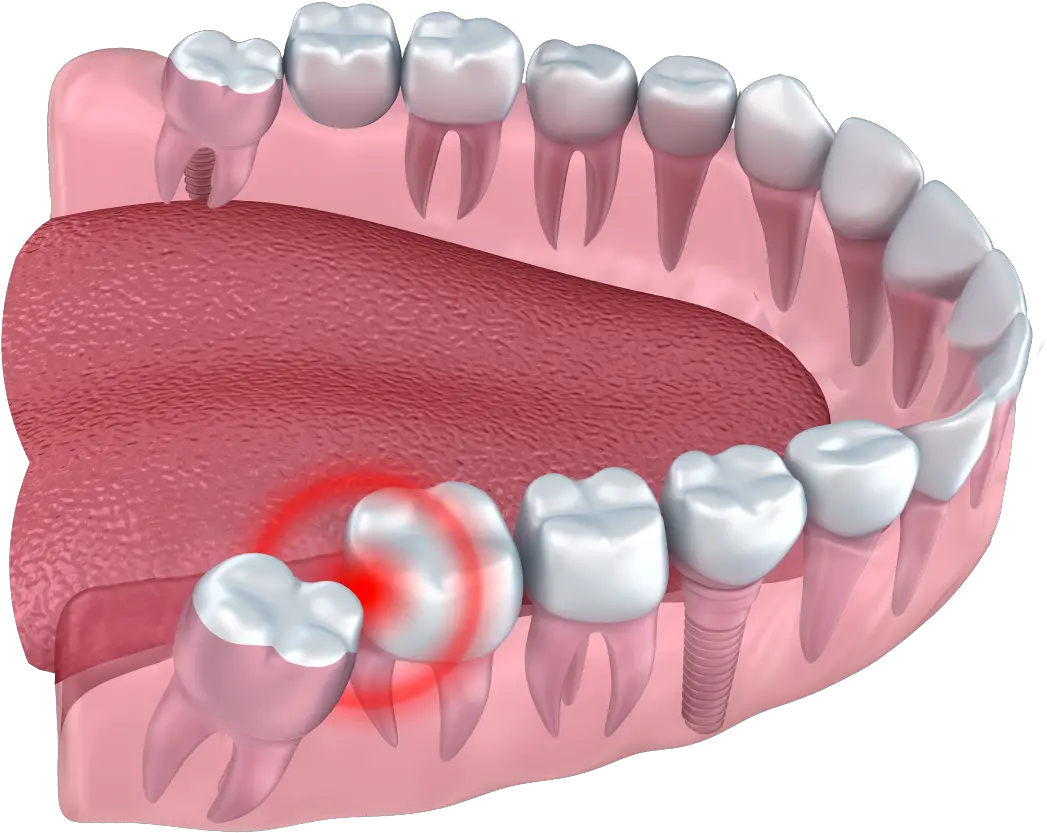  Wisdom Teeth Removal Cardinia Dental Teeth With Wisdom Teeth Png Teeth Png