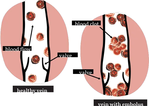  Deep Vein Thrombosis U2014 Womanly Magazine Circle Png Vein Png