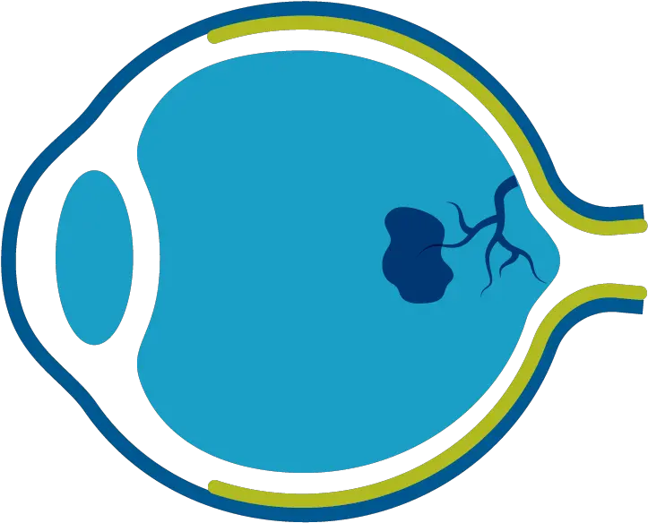  Genentech Understanding Wet Age Related Macular Degeneration Macular Degeneration Eye Clipart Png Amd Icon