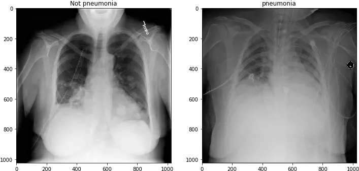  Deep Learning For Detecting Pneumonia From X Ray Images Pneumonia Vs Normal Chest X Ray Png X Ray Png