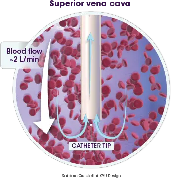  Treating Occluded Catheters Cathflo Activase Alteplase Vertical Png Blood Circulation Icon