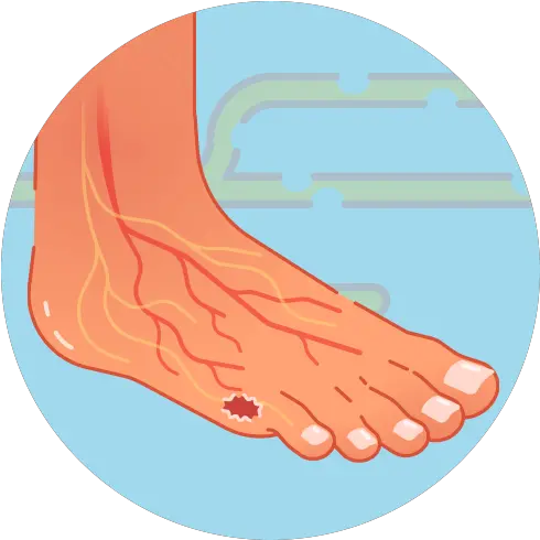  Prevent Diabetic Foot Ulcers And Avoid Amputation U2013 Home Ankle Png Foot Icon Vector