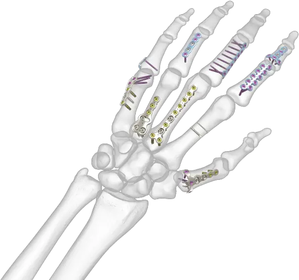  Hand Implants For Doctors And Hand Bones Png Skeleton Hand Png