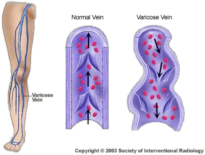  Varicose Vein Treatment In Glen Mills Pa Venous Reflux Vein Png Veins Png