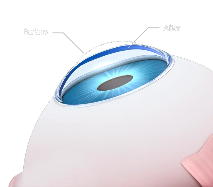  Laser Eye Surgery Circle Png Laser Eyes Png