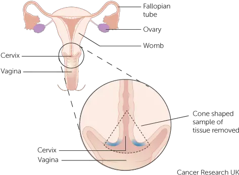  Cone Biopsy Cervical Cancer Research Uk Transformation Zone Of The Cervix Png Vagina Png