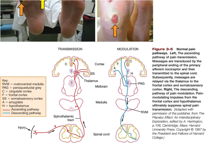  Photos Of Claw Toes Foot Deformity Green Arrow Diagram Png Orange Arrow Png