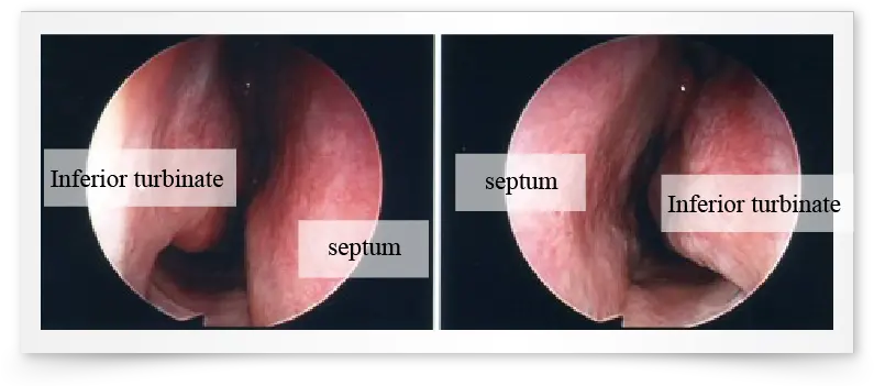  Blocked Nose Normal Nose Vs Blocked Nose Png Nose Transparent