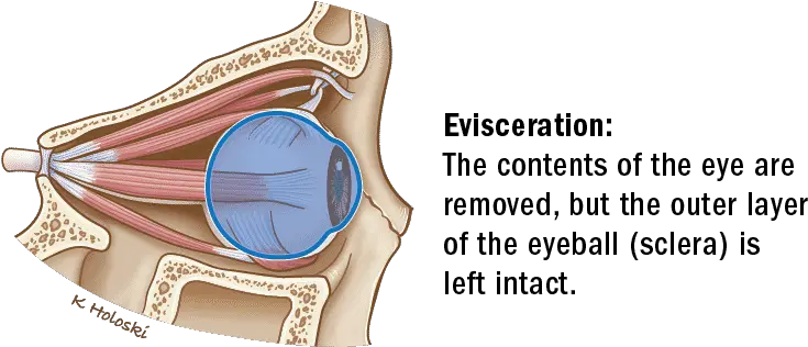  Orbital Eviceration Enucleation U0026 Exenteration Thanc Guide Superior Rectus Muscle Lateral View Png Eye Ball Png