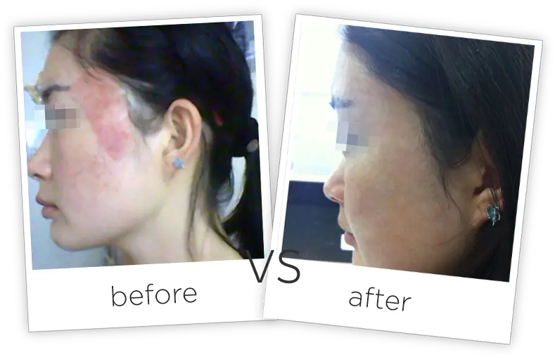  Acne Scars Treatment Adss Laser Number Png Scars Png