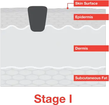  Stage 1 Melanoma Melanoma Research Alliance Playstation Move Png 1 Transparent