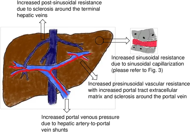  Alterations In Hepatic Hemodynamics A Cirrhotic Liver Hepatic Venous Outflow Obstruction Png Liver Png