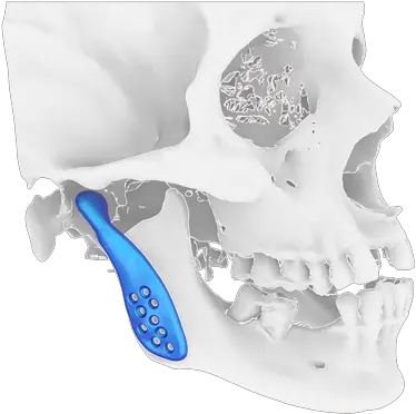  Tmj Prosthesis Protesis De Condilo Mandibular Png How To Wear Your Jawbone Icon