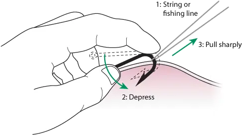  String Method Fish Hook Removal Png Fish Hook Icon