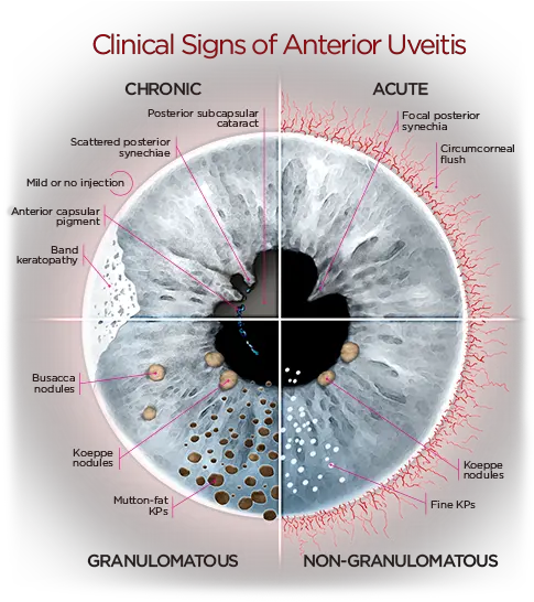  Anterioruveitisdiagrampng 500558 Uveitis Eye Facts Clinical Signs Of Uveitis Human Eyes Png