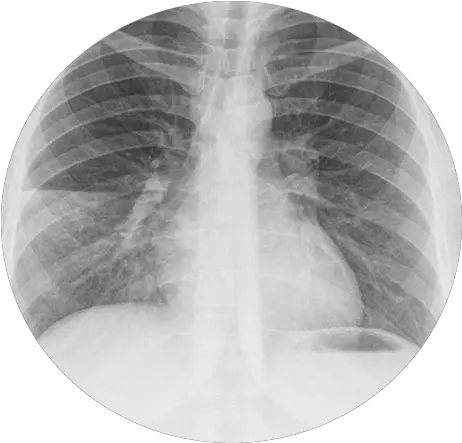  Pneumonia X Ray Medic Mind Png X Ray Png