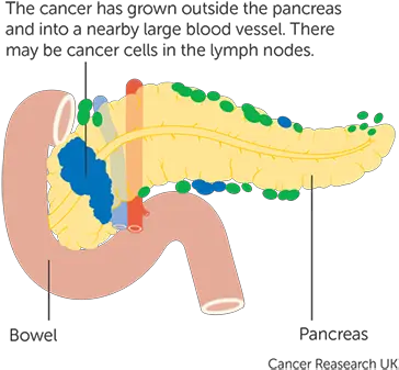  Stage 3 Pancreatic Cancer Diabetes And Pancreatic Cancer Png Stage Png