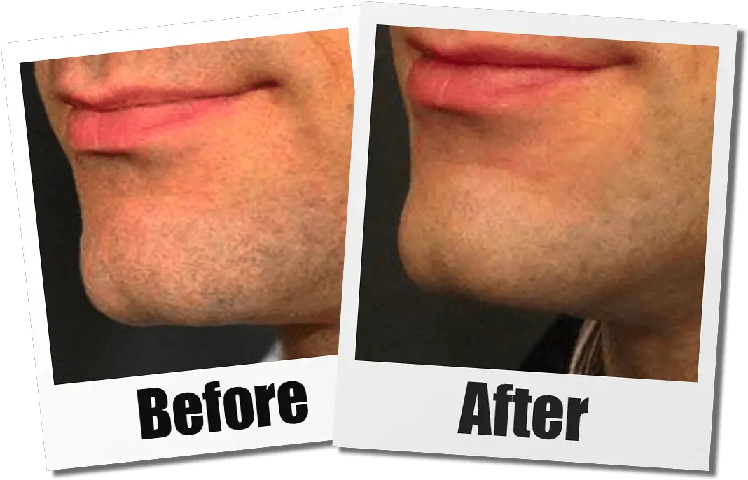  Seattle Chin Implant Non Surgical Chin Augmentation In Seattle Before And After Microcannula Liposuction Png Sync Jawbone Icon