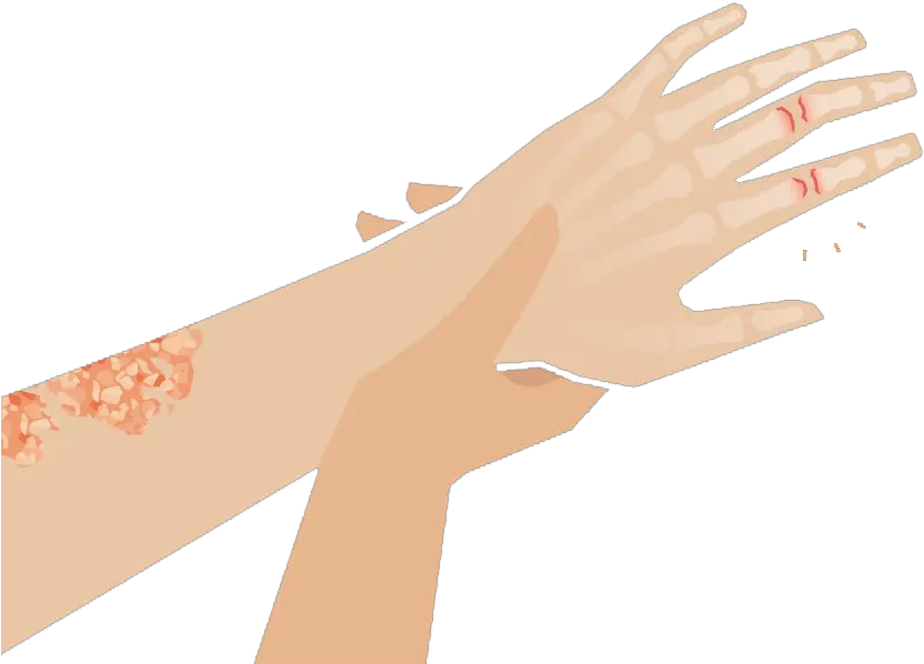  Psoriatic Arthritis Clinlife Sign Language Png Pointing At You Icon