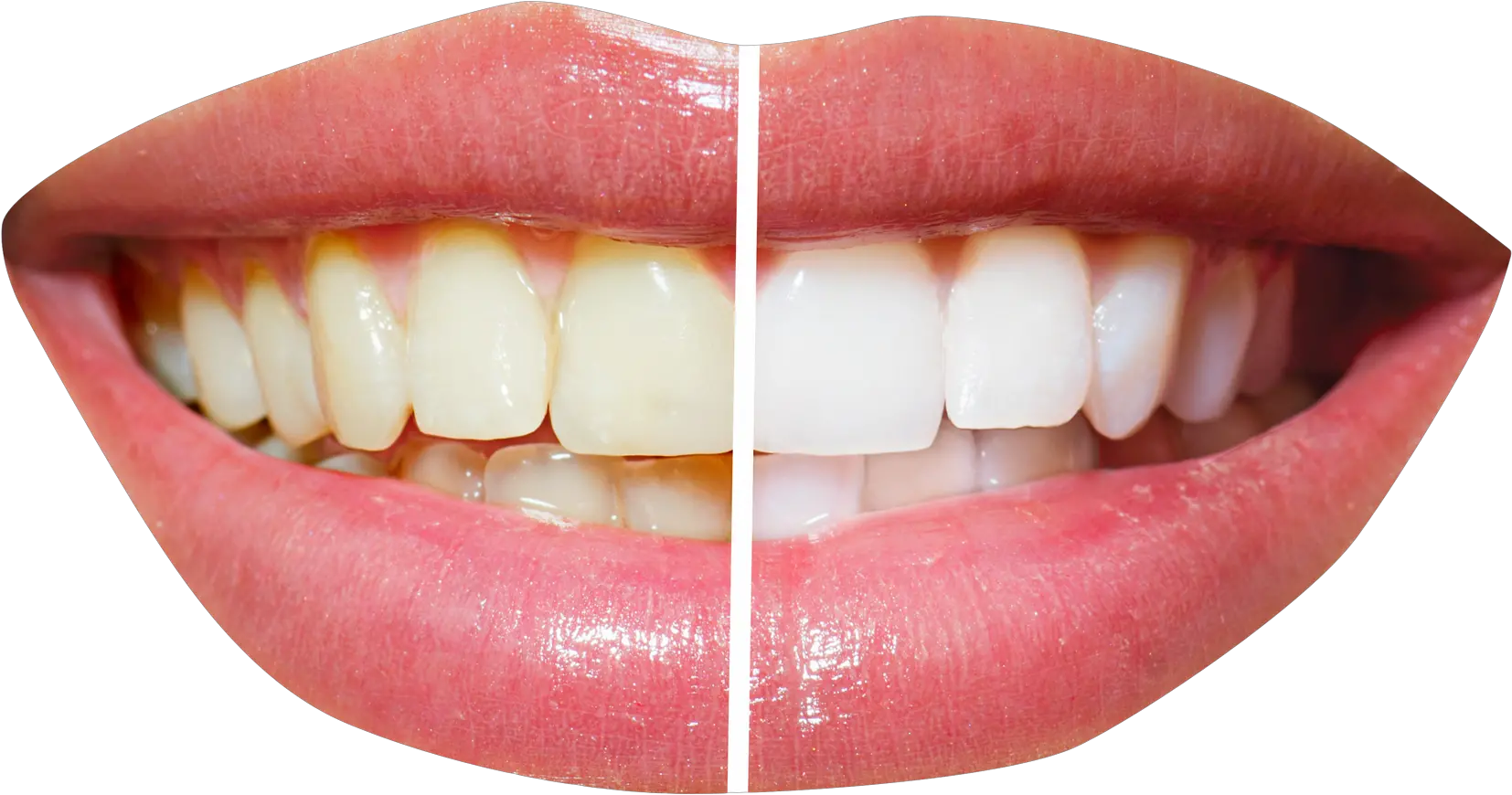  Teeth File Png Transparent Background Teeth Before And After Cleaning Teeth Png