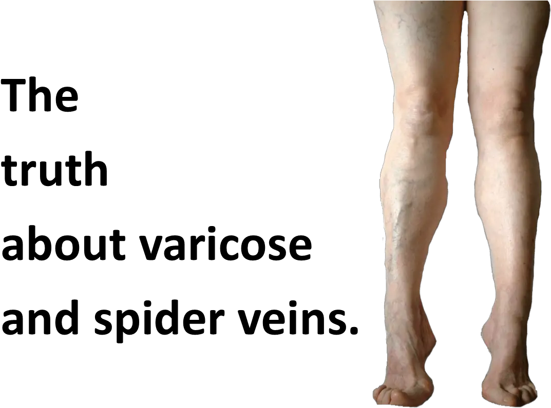  Youu0027re So Vein The Truth About Varicose And Spider Veins For Women Png Veins Png