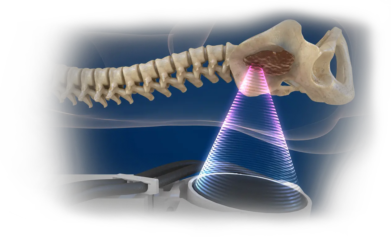  Bone Tumor U0026 Metastatic Cancer Treatment With Mrgfus Rib Png Bone Transparent